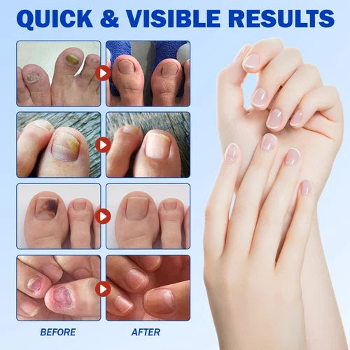 Original Fungal Nail Treatment Patches™